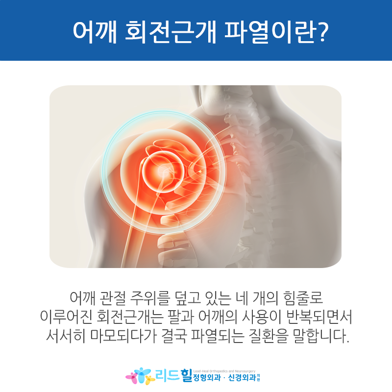 어깨 회전근개 파열 증상의 원인을 살펴보면 2