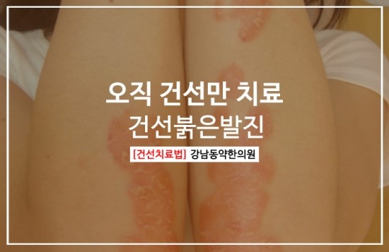 건선한의원에서는 피부의 하얀 각질을 치료합니다 5