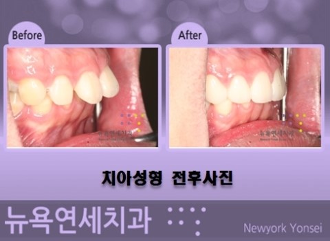  돌출 된 앞니를 치아성형으로 교정하는 방법...