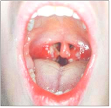 ◘ 류마티스 열(류마티스 열) Rheumatic fever