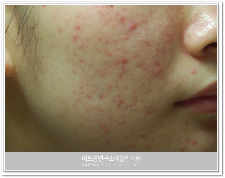 창원여드름한의원 나로 말할것 같으면