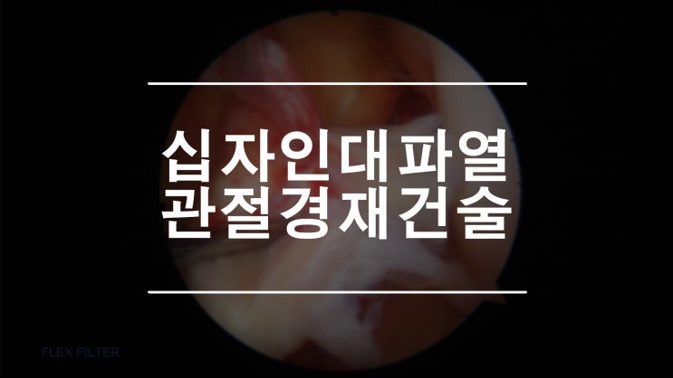  전방십자인대 타가건재건술 불안한 무릎의 동요를 없애는 방법