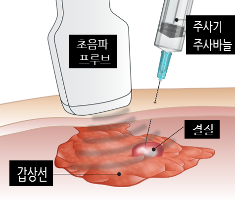갑상선 세침 흡인 세포 검사를 실시할 필요가 있는 경우.