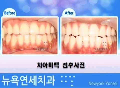 치아미백 원하는 효과를 얻는 방법은 맞춤형 치아미백 시술