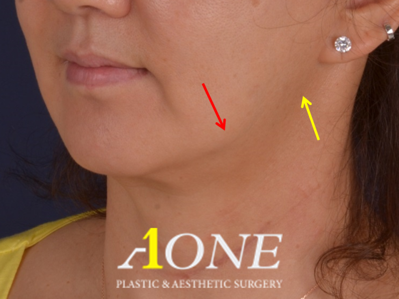 안면윤곽술은 안티에이징의 최대 적이다_Facial Bone Contouring Surgery is the Biggest ...