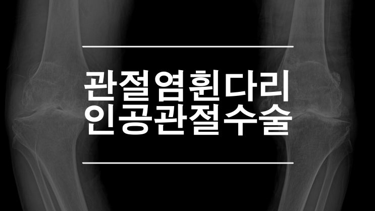  무릎인공관절치환술 퇴행성관절염 으로 고생한 할머니 (TKR)