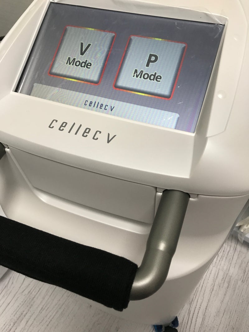 안면홍조를 없애는 방법으로 선택한 셀렉트 cellec 레이저
