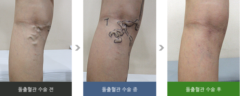 일산 하지정맥류 원인 치료 연세항맥병원