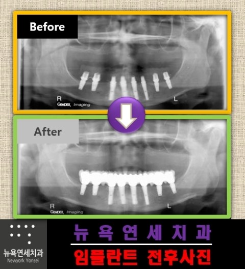  임플란트 수술 가격과 방법을 알아 보고 싶다면 상담을 받아 보시고 결정하세요.