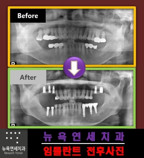  임플란트 전후 사진을 통해서 임플란트 수술 후 어떤 결과를 얻을 수 있는지 확인할 수 있습니다.