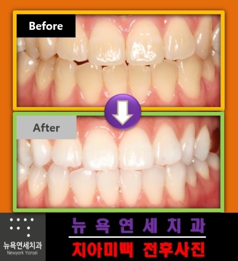  환자에 맞는 맞춤형 치아미백으로 효과를 높이는 방법