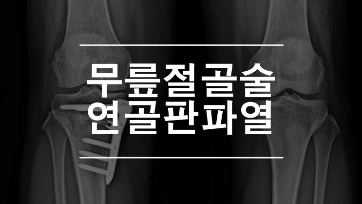  무릎절골술 연골판뿌리파열 의 근본적인 치료 방법 (Open Wedge HTO)