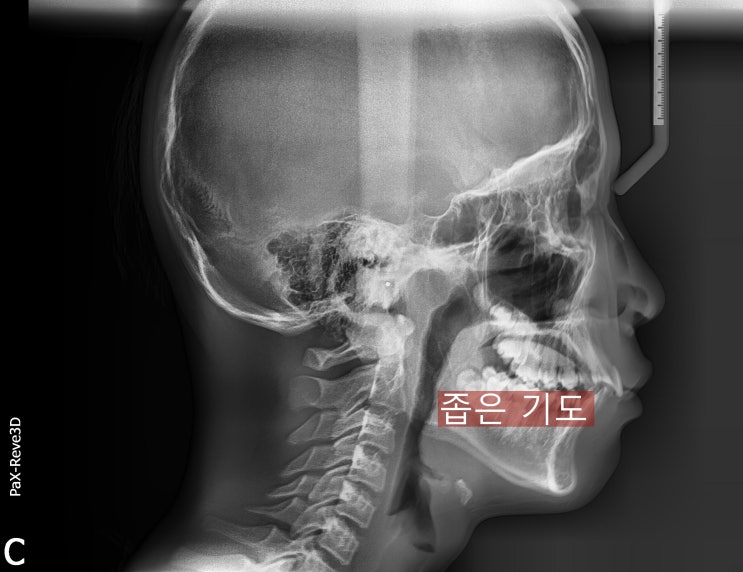  턱관절 치료를 통한 치아 교정과 수면 무호흡 개선