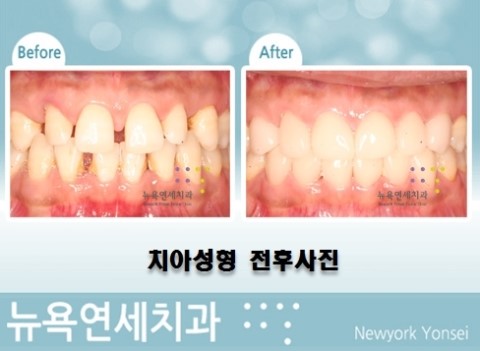  앞니가 벌어진 상태에는 앞니 라미네이트로 치아성형을 하면 됩니다.
