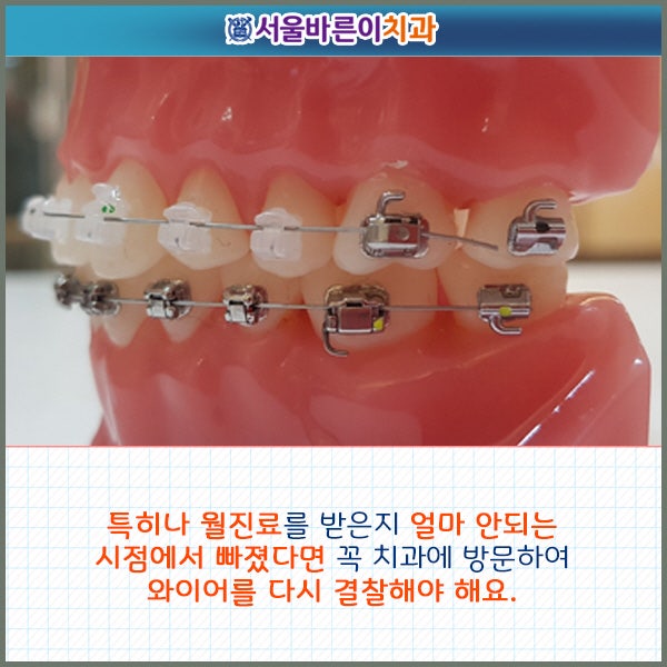 치아교정 중 철사가 빠지면 어떻게 해요? : 네이버 블로그 치아교정 중 철사가 빠지면 어떻게 해요? : 네이버 블로그