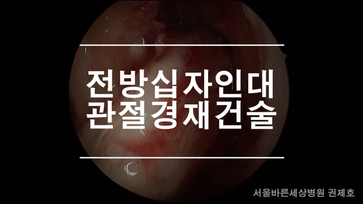  전방십자인대 만성 파열 로 전방십자인대 재건 수술은 제이본정형외과 권제호