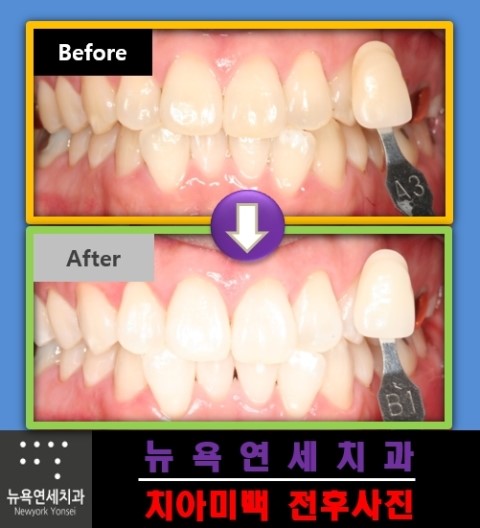  나에게 맞는 치아미백 프로그램을 상담을 통해서 확인 하실 수 있습니다.