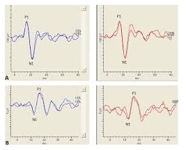  Vestibular Evoked Myogenic Potentials (VEMP)