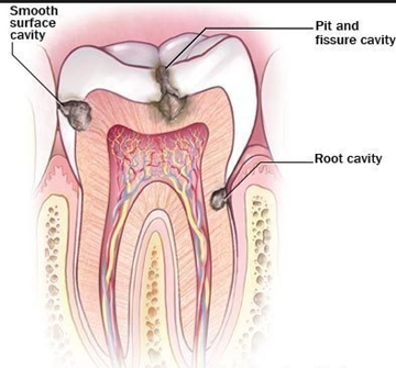치과 아말감 충치치료는 좋은 치료 방법입니다