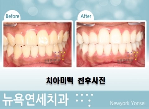  바쁜 일정에는 단기간에 끝나는 원데이치아미백으로 미백 효과를 보실 수 있습니다.