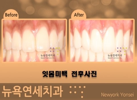  검붉은 잇몸을 선홍빛 잇몸으로 바꾸는 잇몸미백 치료!!