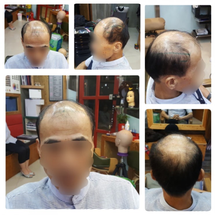  춘천남자 오늘도 모자벗고 맞춤가발 합니다~~