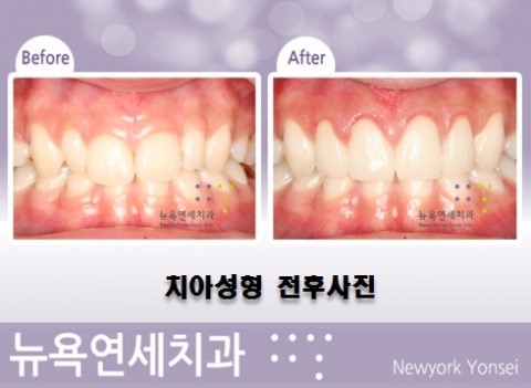  앞니 치아교정 이제는 라미네이트 시술로 1주일 만에 치료 할 수 있습니다.