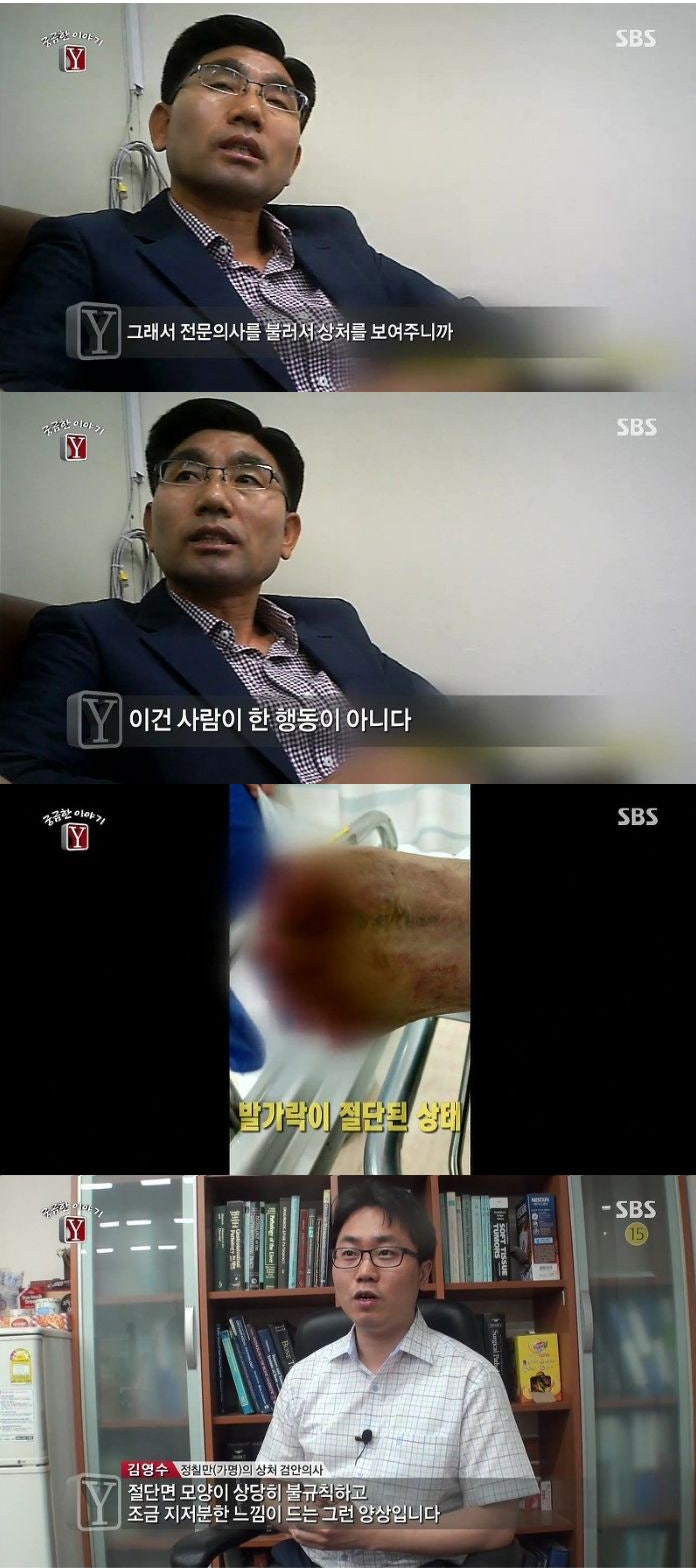 궁금한이야기Y, 사라진 발가락 (발가락 절단 사건) : 네이버 블로그