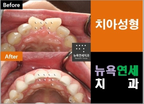 돌출앞니를 치아성형으로 교정을 한 시술 사례를 정리해 봅니다.