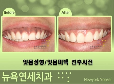  잇몸성형시 잇몸미백이 필요한 경우에 대해서 전후 사례로 확인을 해보겠습니다.