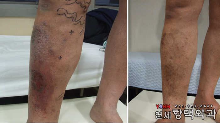 일산 하지정맥류 피부괴사 치료 전후사진