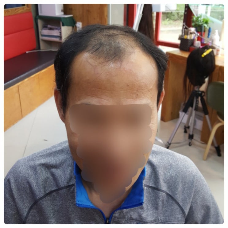  #춘천가발 #맞춤가발 #부분가발 속초남자도 모자 벗깁니다~