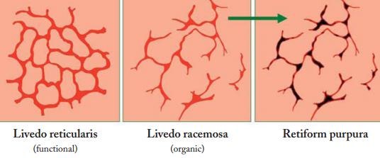망상 발적 피부(Livedo reticularis) : 네이버 블로그