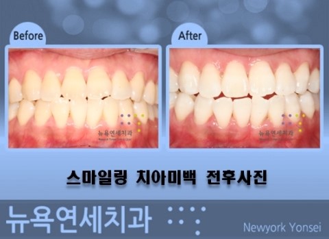  치과의 치아미백 프로그램은 여러가지가 있습니다.