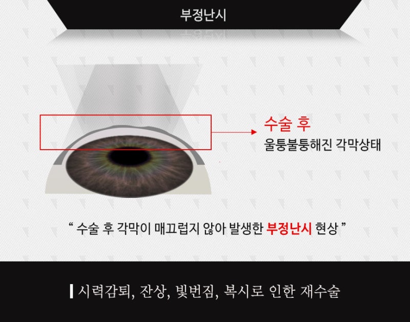 라식 라섹 재수술 한번 더 따져보세요! : 네이버 블로그 라식 라섹 재수술 한번 더 따져보세요! : 네이버 블로그