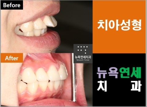  돌출 앞니를 간단하게 올세라믹으로 앞니 교정하기