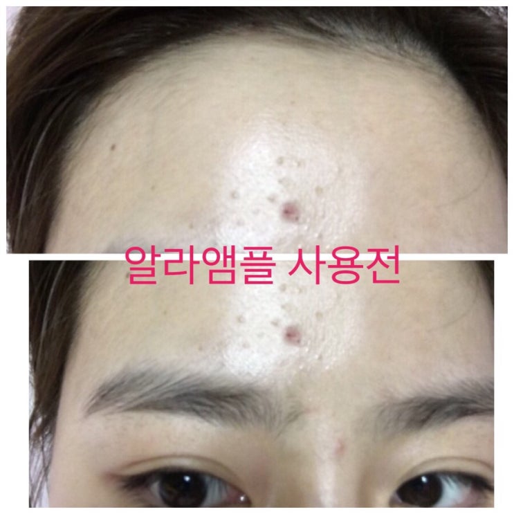  [제플뷰티] 알라앰플 /좁쌀계의 혁명템"