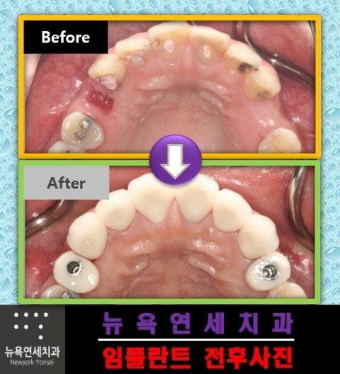  고난이도의 치과 치료인 임플란트 수술 전후 사례 보기