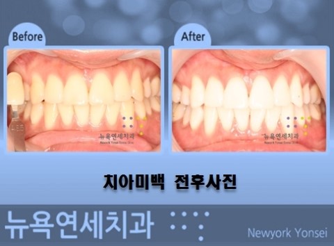 치아교정 후에는 맞춤형 치아미백을 통해서 심미적인 효과를 높일 수 있습니다.