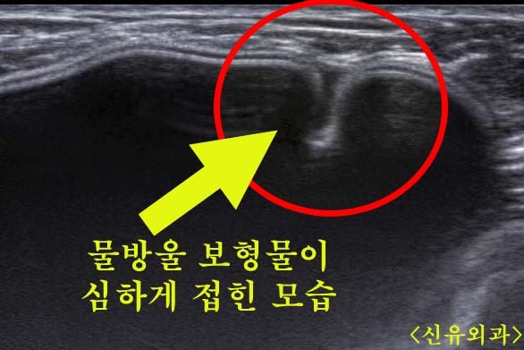 가슴보형물제거후 불편함으로 오신 분: 후관리도 수술의 중요한 한 부분입니다.