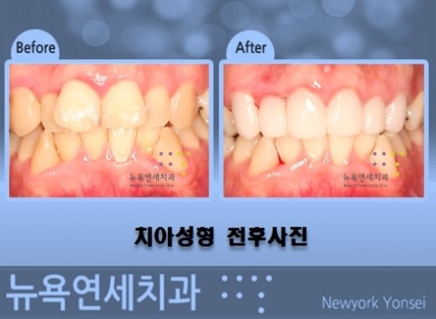  앞니 올세라믹으로 삐뚤빼뚤 한 앞니를 고르게 치아성형 하기
