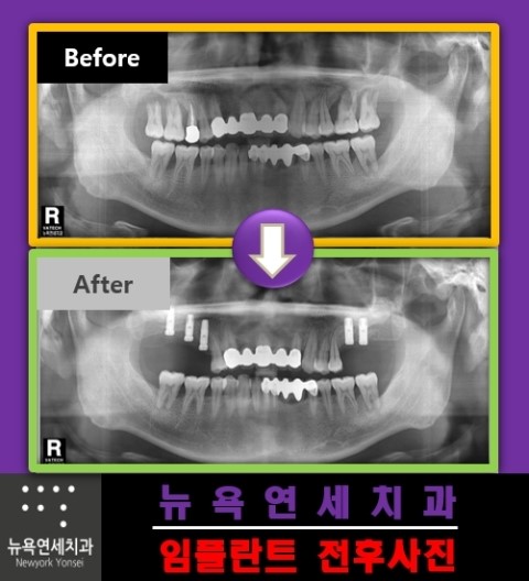 어금니 부분의 치아에 임플란트 시술이 이루어진 전후 사례들