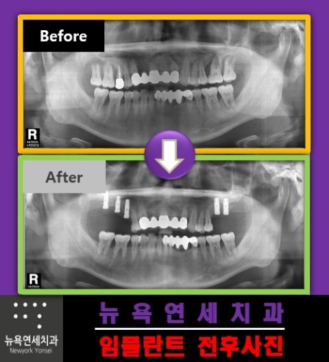  어금니 부분의 치아에 임플란트 시술이 이루어진 전후 사례들