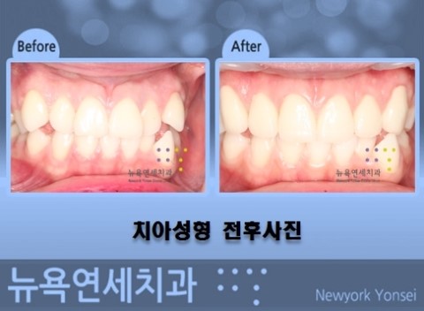 앞니 치아를 치아성형하는 방법을 전후 사진을 통해서 확인하기