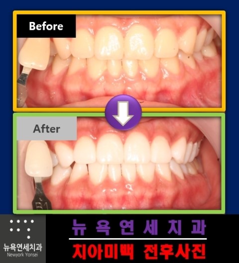  뉴욕연세 치과에서 운영하는 치아미백 프로그램 중 스탠다드 치아미백 전후
