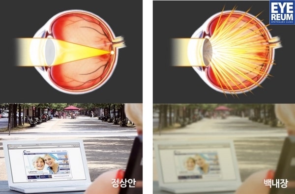 [아이리움] 당뇨환자, 백내장 수술 시 주의사항은?