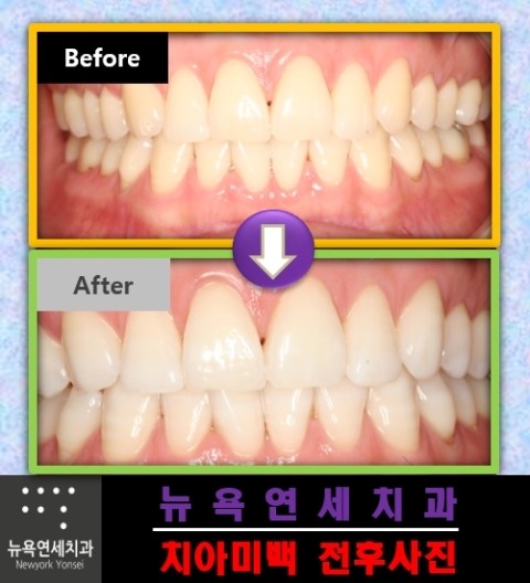 치아의 색상에 따라서 치과에서 받는 치아미백의 종류는 다릅니다.