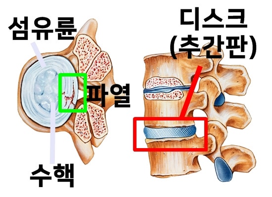 부산목디스크병원? 반드시 00을 부산목디스크병원? 반드시 00을