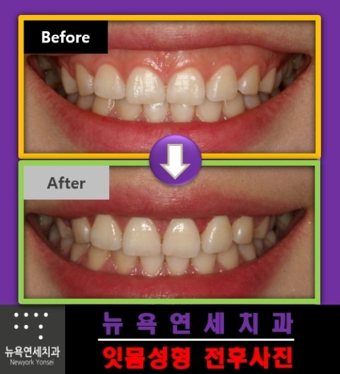  거미스마일 잇몸을 구강전정수술로 치료를 한 전후 사례
