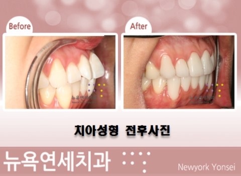  올세라믹으로 앞니를 치아성형하는 심미치과 치료 전후 사진